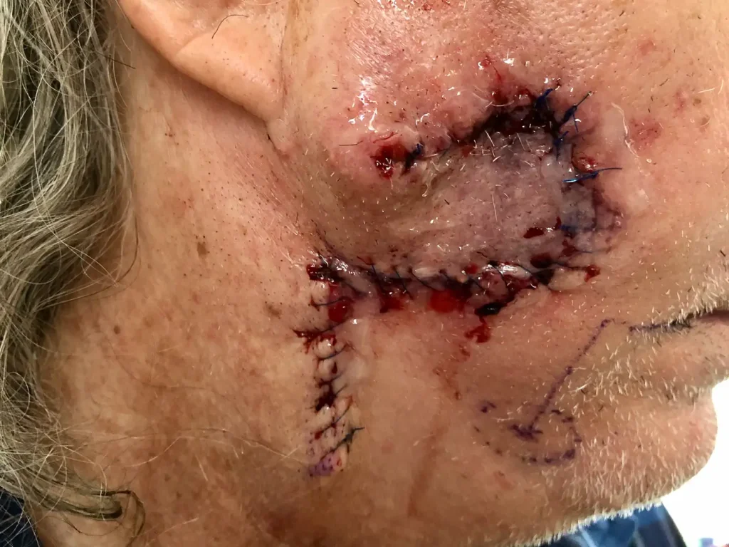 Desmoplastic Melanoma